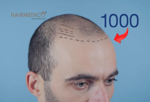 1000 Graft FUE 2025