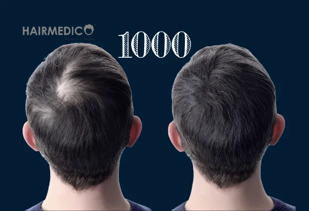 1000 Hair Grafts Before and After 2025