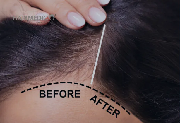1500 Hair Grafts Before and After 2025