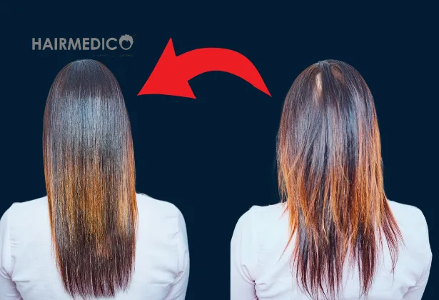 2000 Grafts Hair Transplant Before and After 2025
