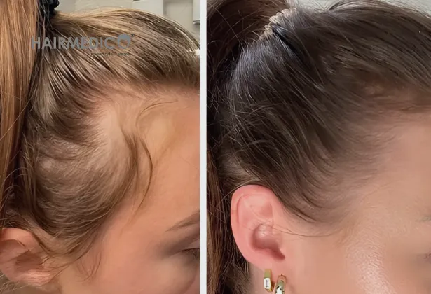 2500 Grafts Hair Transplant Before and After 2025