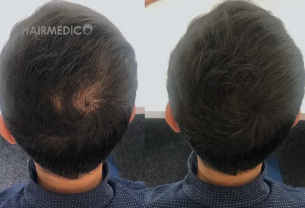 3000 Grafts Hair Transplant Before and After 2025