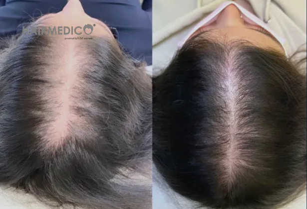 3000 Hair Grafts Before and After 2025