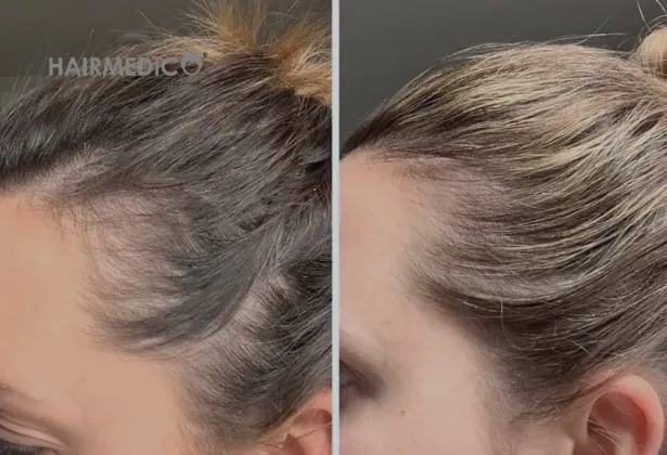4500 Grafts Hair Transplant Before and After 2025