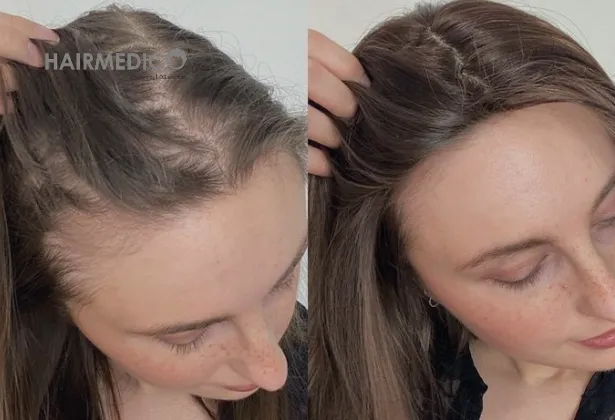 500 Hair Grafts Before and After 2025