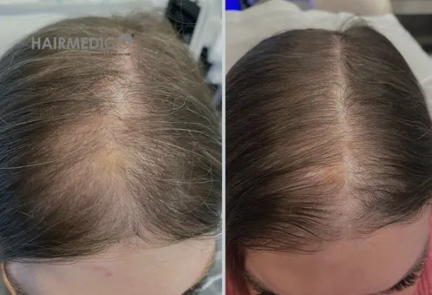 5000 Grafts Hair Transplant Before and After 2025