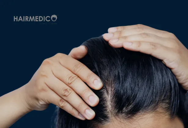 8000 Grafts Hair Transplant 2025