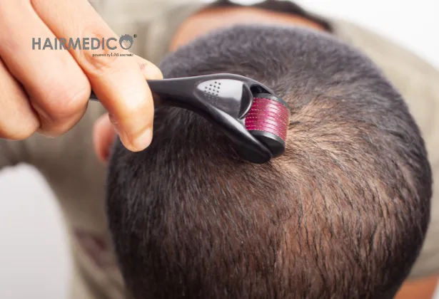 Best hair restoration products for baldness 2025 | Hairmedico Guide