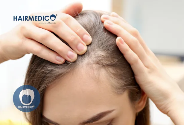 Female Hair Transplant in Turkey – Best Hair Restoration in Istanbul