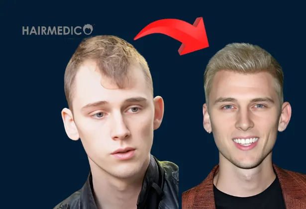 Has Machine Gun Kelly Had a Hair Transplant? The Truth Revealed