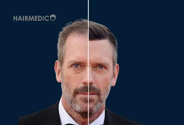 Hugh Laurie Hair Transplant: Did He Undergo a Hair Restoration Procedure?