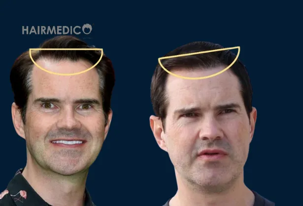 Jimmy Carr Hair Transplant – Did He Restore His Hairline?