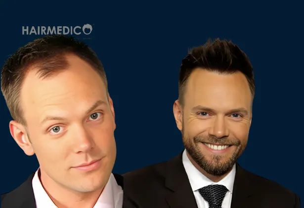 Joel McHale Hair Restoration – Did He Get a Hair Transplant?
