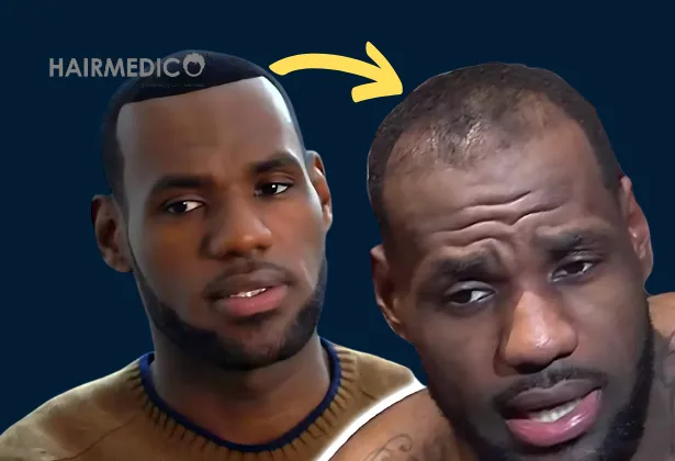 LeBron James Hair Transplant – How He Restored His Hairline