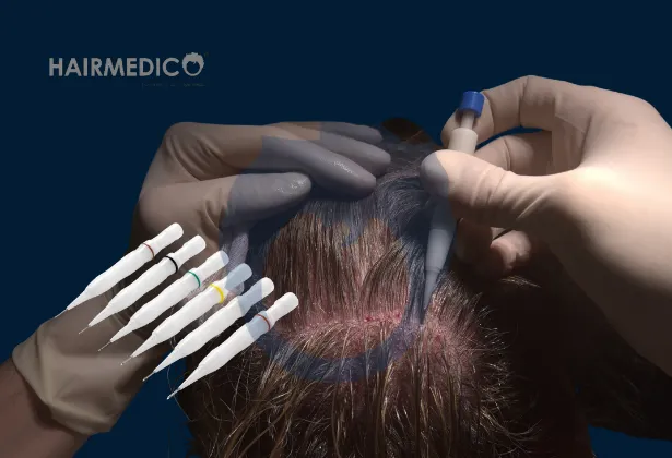 DHI Hair Transplant 2025: Latest Methods and Technological Advances