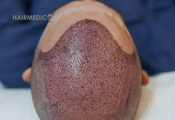 Sapphire FUE Hair Transplant Technique 2025