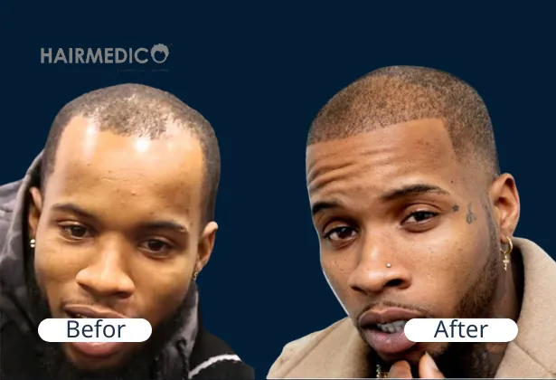 Tory Lanez Hair Transplant: His Journey to a Fuller Hairline