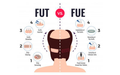 Quelle Difference Entre Greffe De FUE Et Greffe De Cheveux FUT?